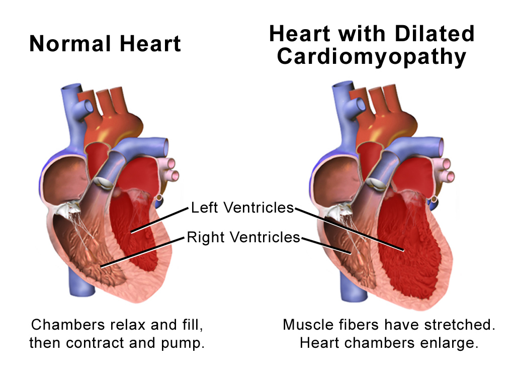 What Is Cardiomyopathy 